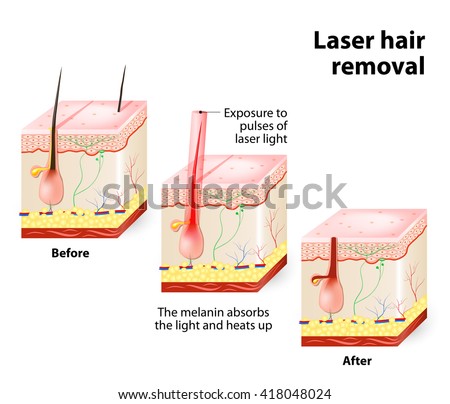 The laser emits an invisible light which penetrates the skin without damaging it. At the hair follicle, laser light absorbed by the pigments is converted into heat. This heat will damage the follicle.