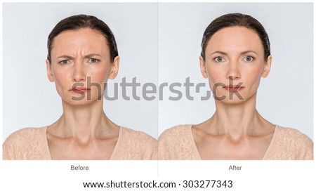 Concept of botox procedure. Middle age Woman with and without aging singes - worry wrinkles, nasolabial folds before and after cosmetic or plastic procedure, anti-age therapy, lips volume