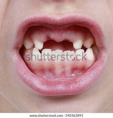 Closeup of child\'s mouth with missing teeth