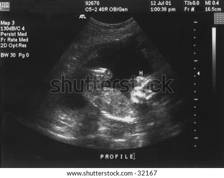 stock-photo-ultrasound-of-a-baby-at-around-fourteen-weeks-32167.jpg