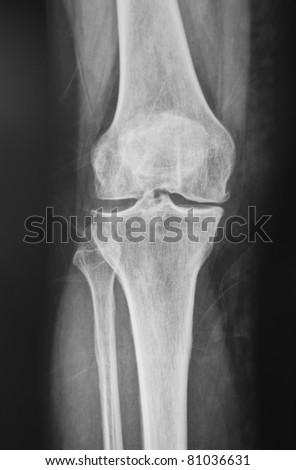 normal knee