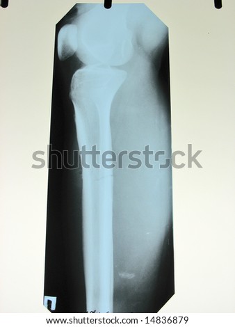 xray of a broken leg bone