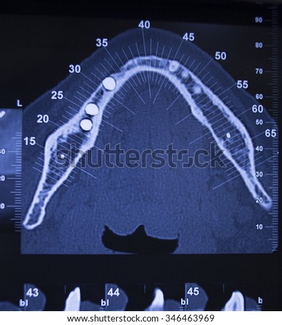 Dental x-ray scans on scanning viewer in dentists office clinic.