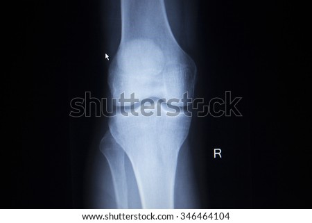 X-ray orthopedic medical CAT scan of painful knee meniscus injury leg in traumatology hospital clinic.