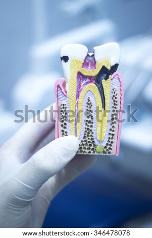 Dental tooth model cast showing decay casing pain, enamel and roots in profile interior of tooth photo.