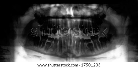 X-ray of Human Jaw Bone