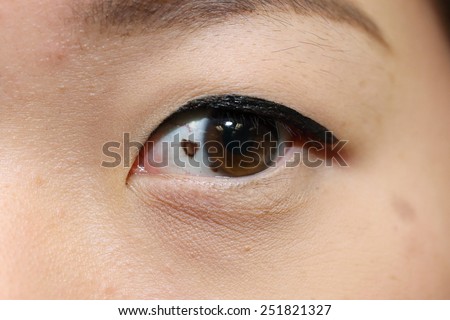 close up of suspicious mole on asian woman eye