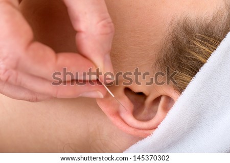 Close-up of an acupuncture needle on an ear. Close-up of a chiropractor applying an acupuncture needle on the ear of blond woman