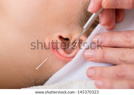 Homeopath treating woman with acupuncture. Close-up of a chiropractor treating woman with ear acupuncture techniques  also known as auriculotherapy