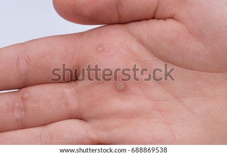 Common wart ( Verruca vulgaris ) a flat wart commonly found on the hands and feet of children and young adults. They are caused by a type of human papillomavirus ( HPV )