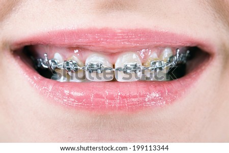 smile with braces on teeth