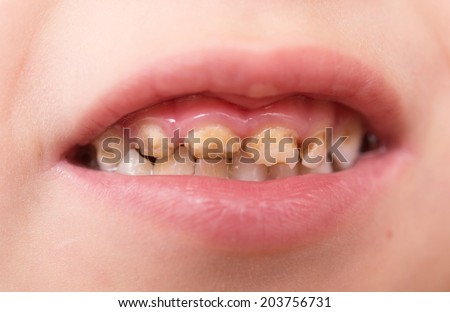 child bad teeth