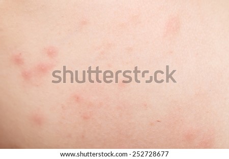 rash on human skin