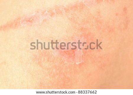 close up of bad skin