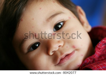 Nine month old baby boy with chicken pox