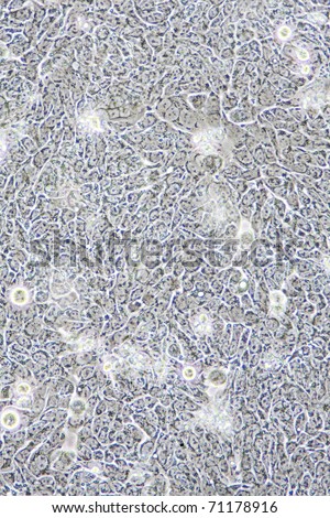 Microscope view of Colon Cancer cells in tissue culture showing walls and nucleus.