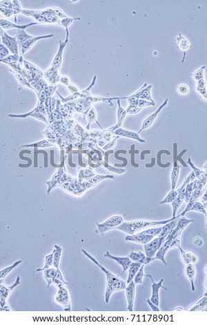 Microscope view of Prostate Cancer cells in tissue culture showing walls, nucleus and organelles.