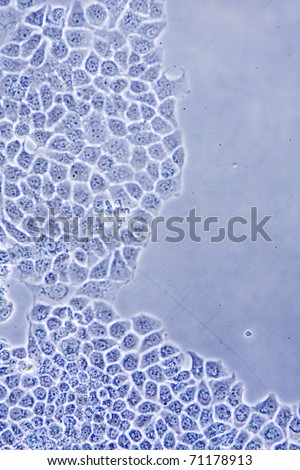 Microscope view of ductal Breast Cancer cells in tissue culture showing walls, nucleus and organelles.