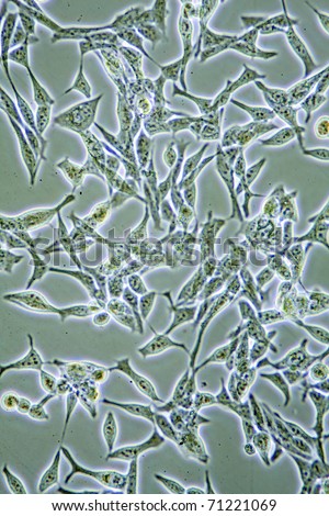 Microscope view of mens health Prostate Cancer cells in tissue culture showing walls, nucleus and organelles.