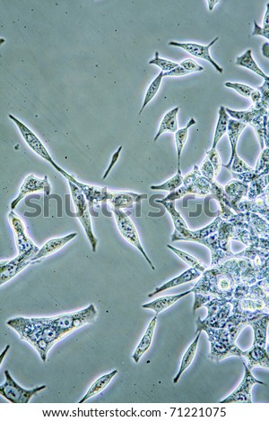 Microscope view of mens health Prostate Cancer cells in tissue culture showing walls, nucleus and organelles.