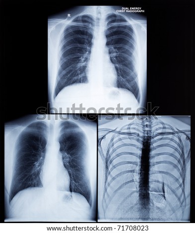 X-Ray Image Of Human Healthy Chest