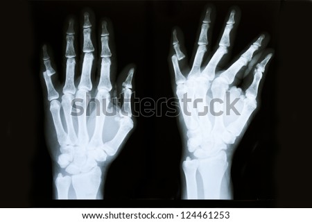 X-ray of human hands injury