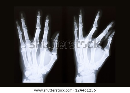 x-ray film of hand 2 position