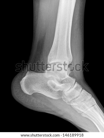 Left foot ankle Xray