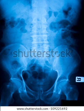 x ray film of Stones in the  Kidney ( 2 stones in the left kidney)