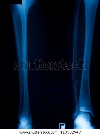 X ray film of  bone leg fracture.