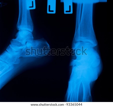 X ray film  of ankle  fracture