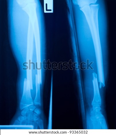 X ray film of  bone leg fracture.