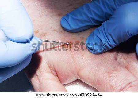 Microsurgery: Dermatologist doctor removing skin  disease