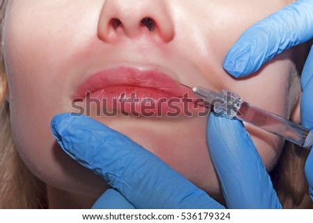 Dermatologist performs contour plastic in the lips with hyaluronic acid filler