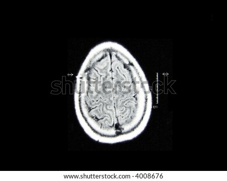 A real MRI/ MRA (Magnetic Resonance Angiogram) of the brain vasculature (arteries) in monochrome