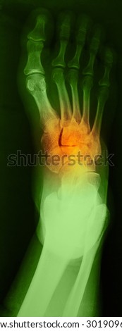 Right foot ankle Xray, top view