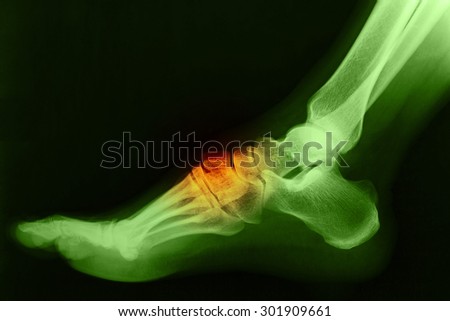 Broken right foot ankle Xray, side view