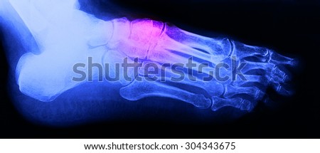 Right foot ankle Xray