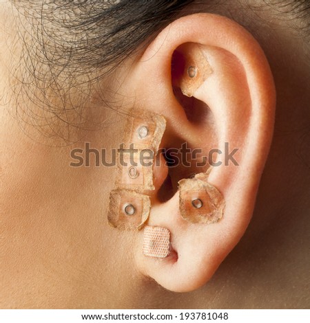 Macro close up of auriculotherapy treatment on human ear.
