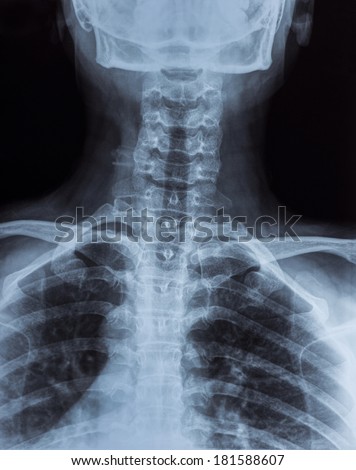 X-ray image of Abnormalities human neck bone ( cervical vertebra)