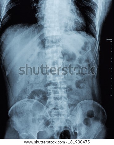 X-ray image of Abnormalities human spinal column continually with pelvic