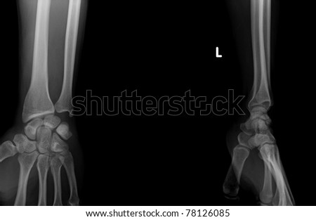Left fist on x-ray, health care medical photo