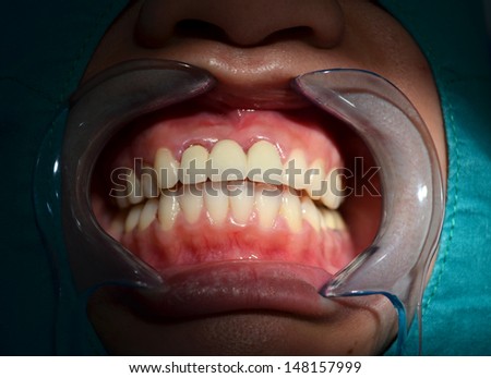 All ceramic bridge of anterior upper teeth