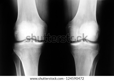 Human knee xray front photo
