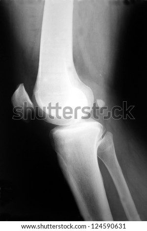 Human knee x-ray side photo