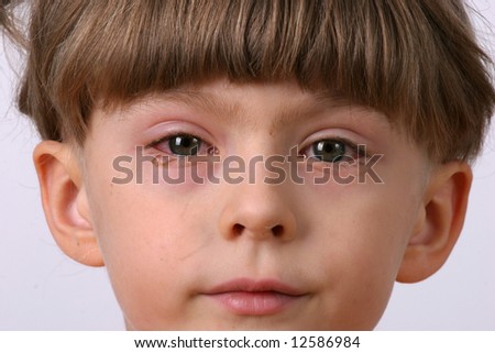 conjunctivitis - ill allergic eyes