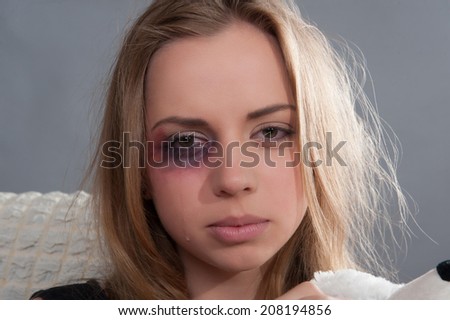 Poor young scared girl with black eye thinking about her heavy-handed father and crying