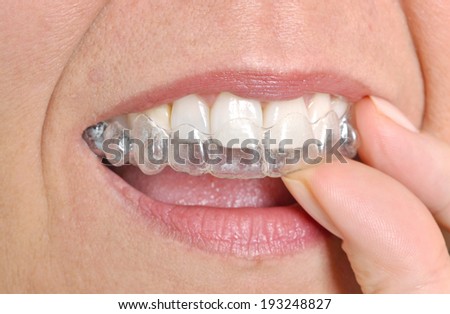 Woman putting in her invisible braces