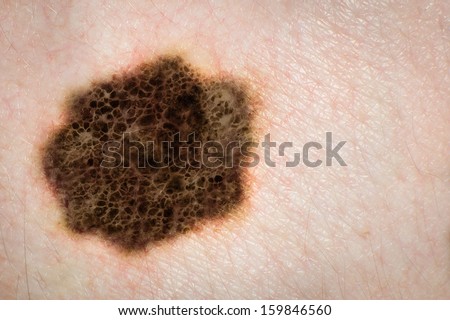 Melanoma, skin cancer, mole. High definition image.