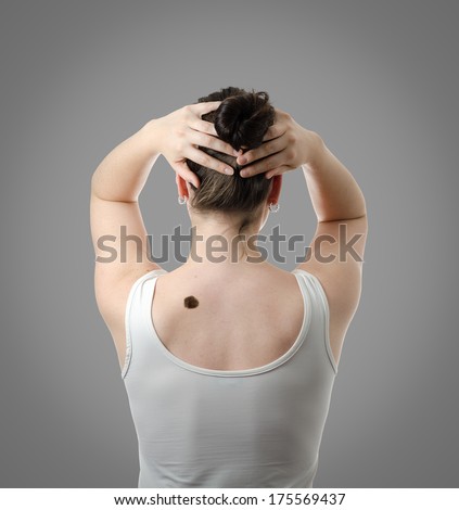 Dramatic picture of a melanoma (skin cancer, mole) on the back of a woman. High definition image.